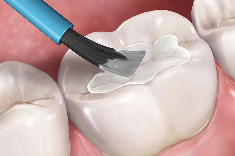 Phương pháp trám răng dễ tiến hành, thời gian thực hiện nhanh và chi phí thấp mà không gây ảnh hưởng đến răng