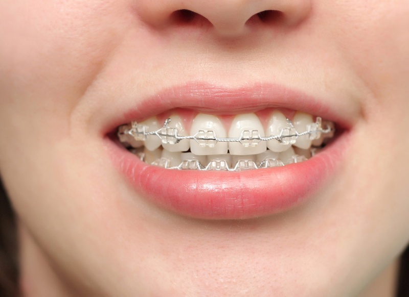 Răng bị nứt có niềng được không?2