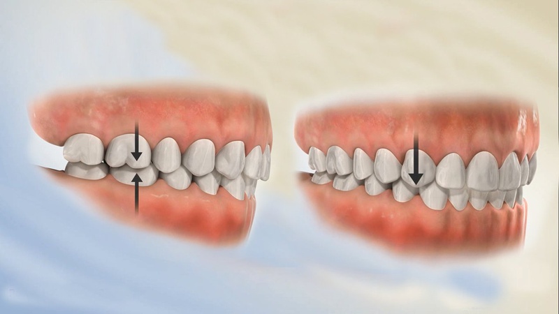 Răng bọc sứ bị viêm tuỷ là do đâu