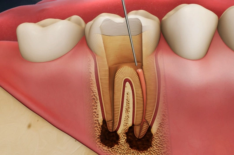 Răng chết tủy có niềng được không, cần lưu ý gì khi niềng