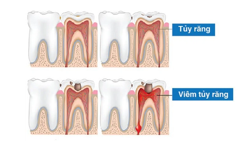 Răng chết tủy dễ dẫn đến nhiều vấn đề liên quan đến sức khỏe răng miệng