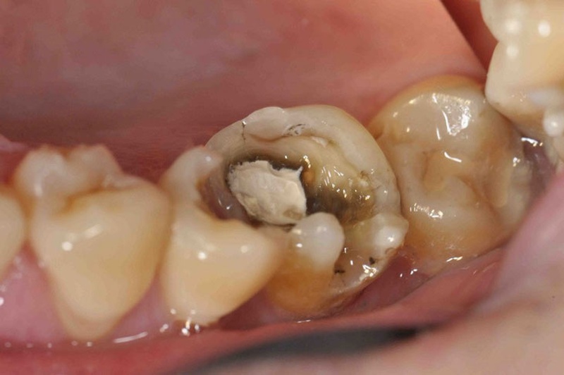 Sâu răng là một nguyên nhân rất lớn và thường gặp dẫn đến tình trạng tủy răng bị chết