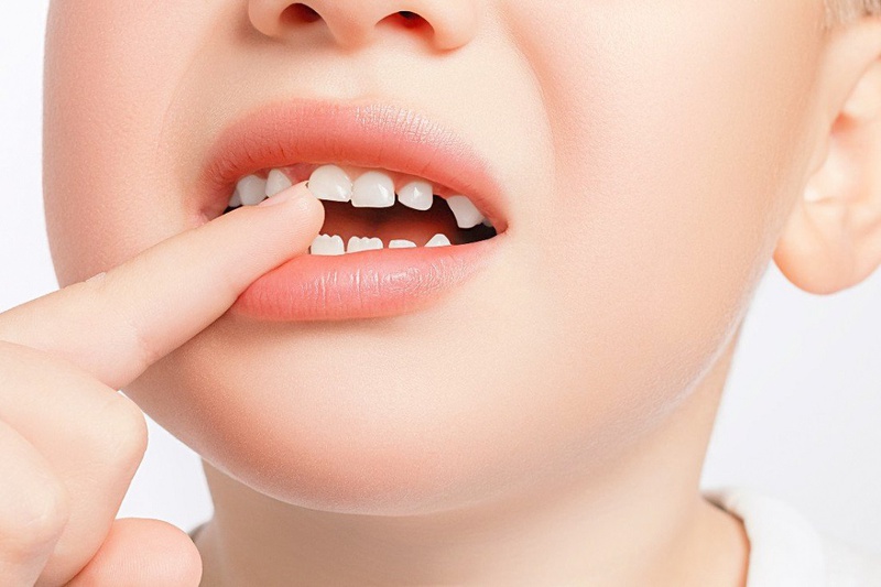 Các dạng răng cửa mọc lệch