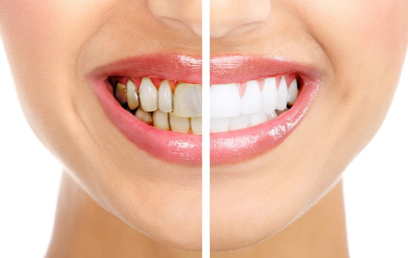 Tẩy trắng răng tại nhà có thể khiến tình trạng răng ê buốt kéo dài nêu không làm đúng cách