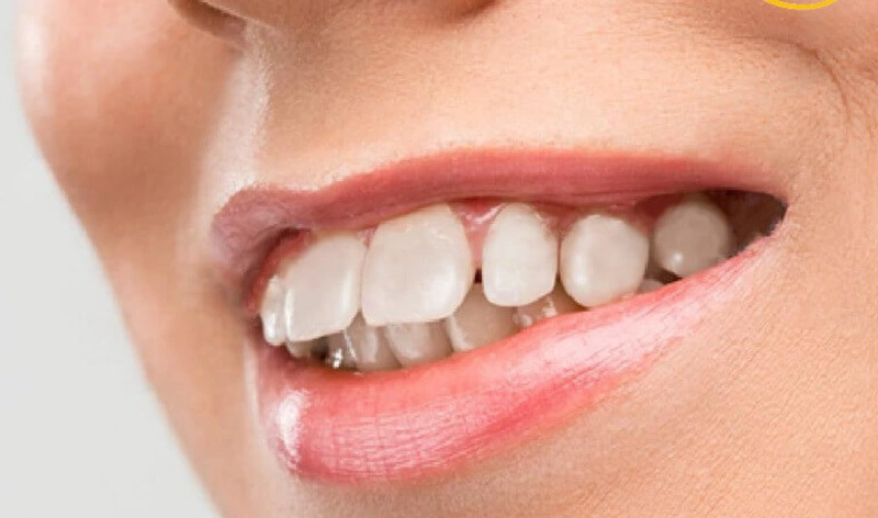 Răng lung lay khi niềng có ảnh hưởng gì không?