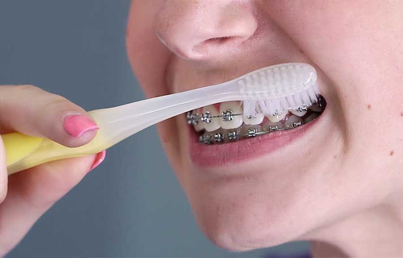Răng lung lay khi niềng có ảnh hưởng gì không?2