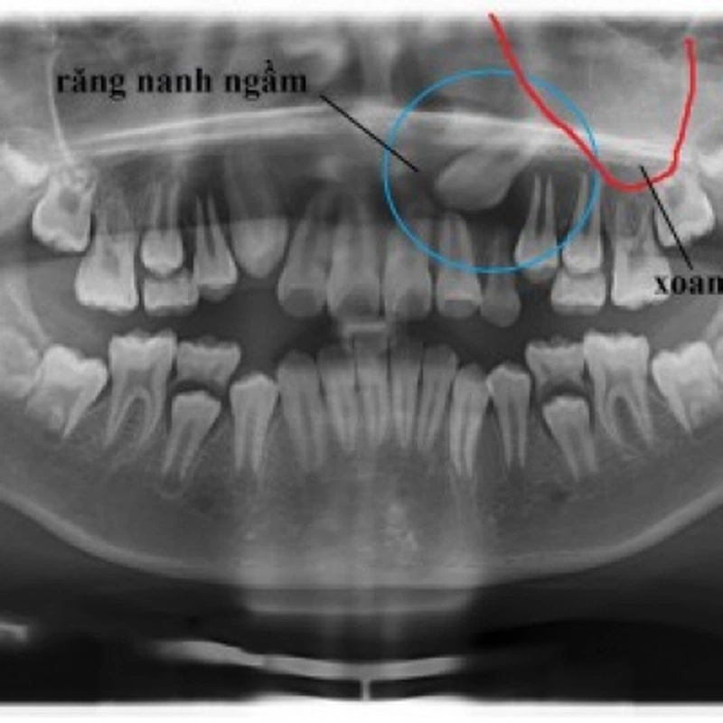 răng mọc ngầm có nên nhổ hay không