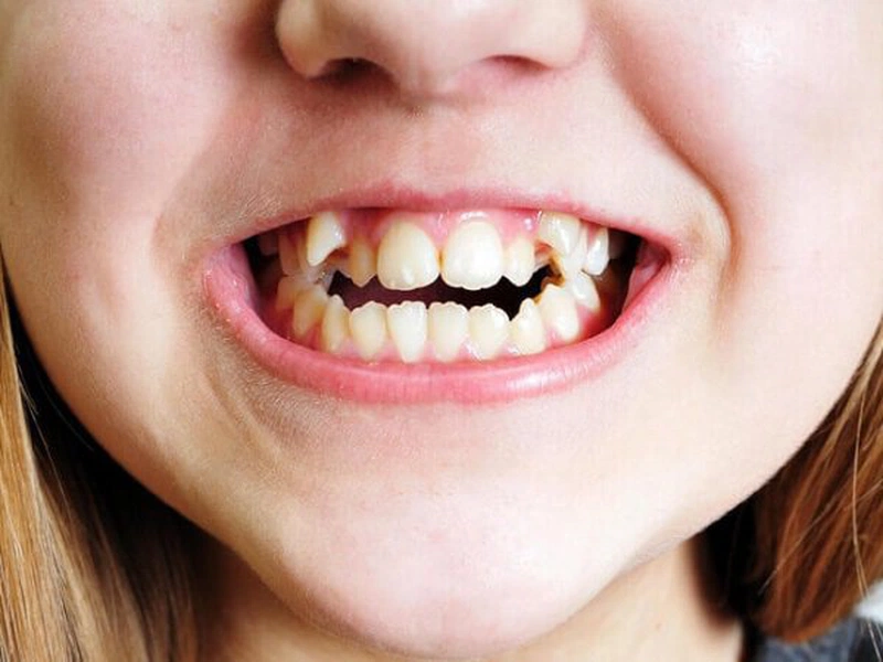 Tình trạng mọc răng thừa khiến các khớp ăn