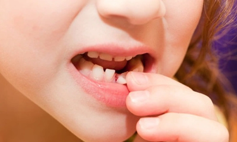 Nguyên nhân mọc răng thừa có thể do cơ địa cơ thể hoặc bị thừa chất dinh dưỡng