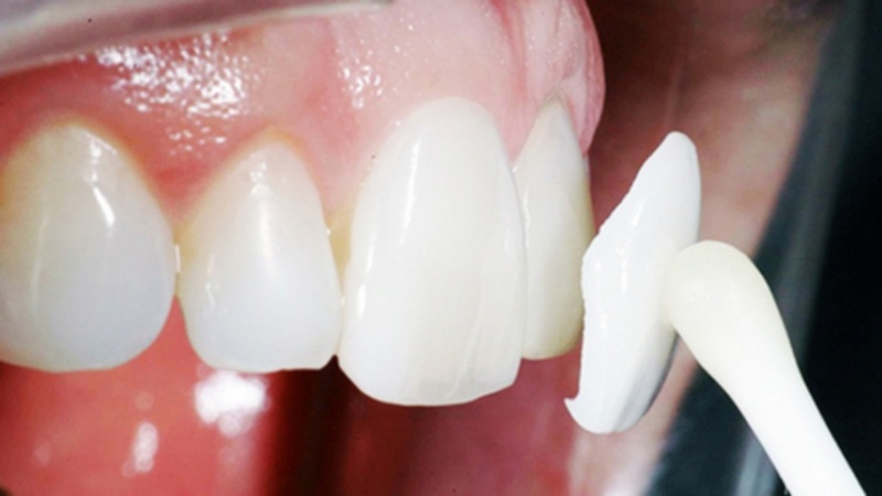 Cách xử lý răng bị nhiễm fluor: Dán răng sứ Veneer