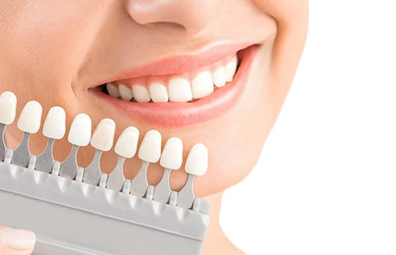 Răng nhiễm Tetracycline mức độ nặng có thể dùng dán sứ veneer