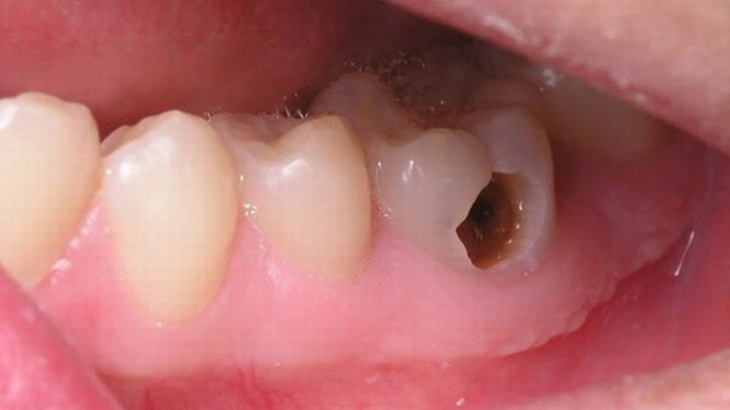 Răng sâu bị vỡ phải xử lý như thế nào? Cách phòng tránh răng sâu bị vỡ 2