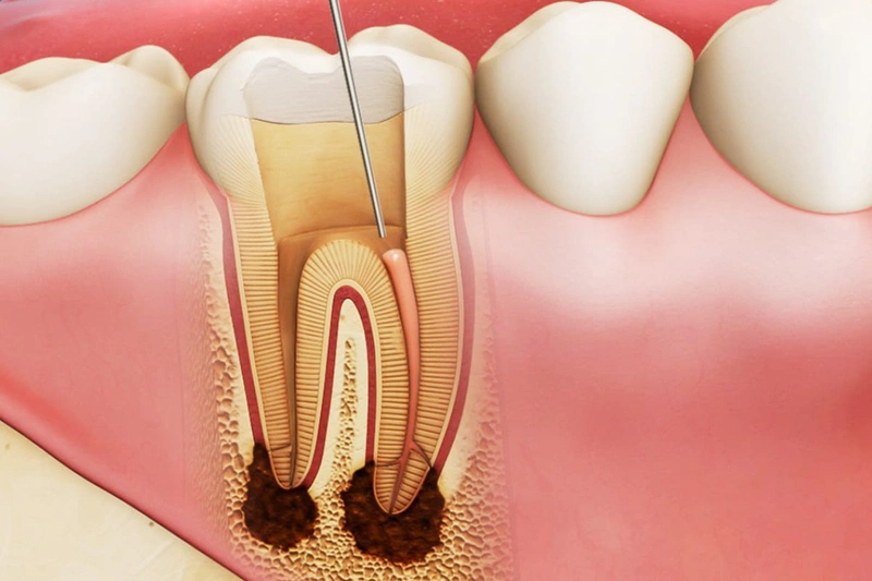 Răng sâu bị vỡ phải xử lý như thế nào? Cách phòng tránh răng sâu bị vỡ 3