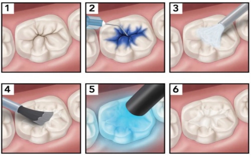 Răng sâu có lỗ phải làm sao? Cách trị sâu răng có lỗ 2