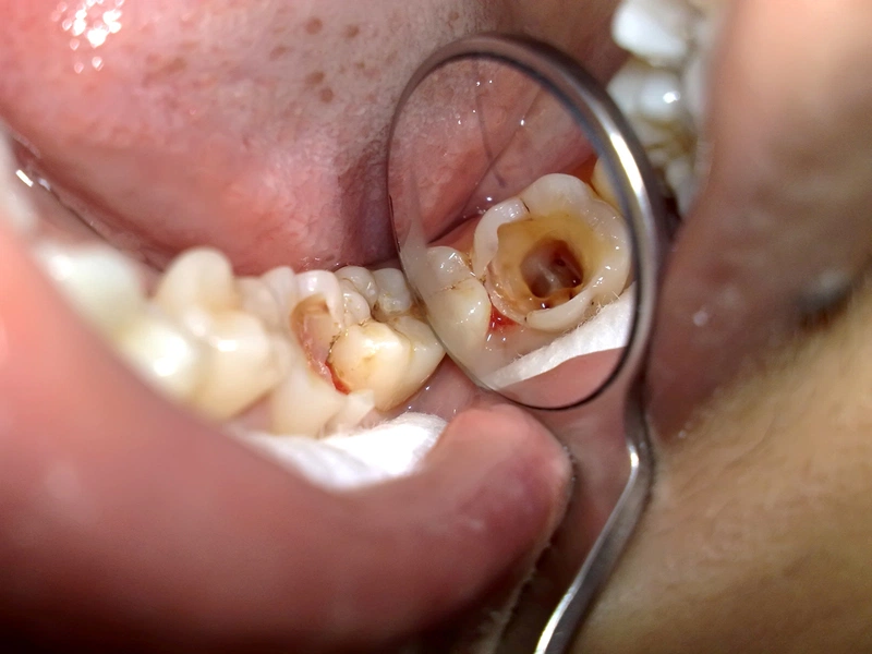 Răng sâu có niềng được không?2
