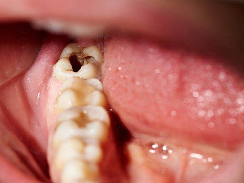 Răng sâu có niềng được không?1