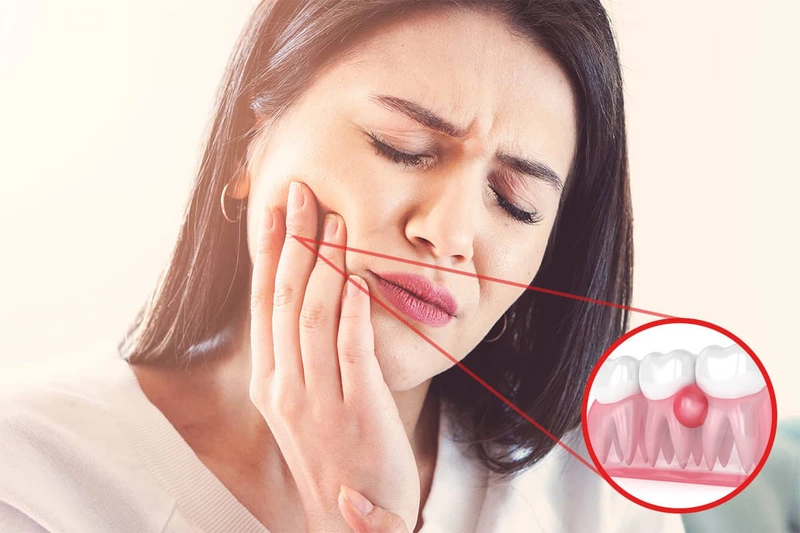 Răng sâu lồi thịt có làm sao không Điều trị như thế nào 1