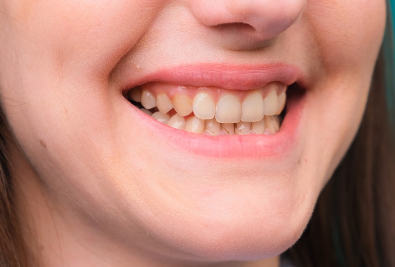 Răng sâu lồi thịt có làm sao không Điều trị như thế nào 2