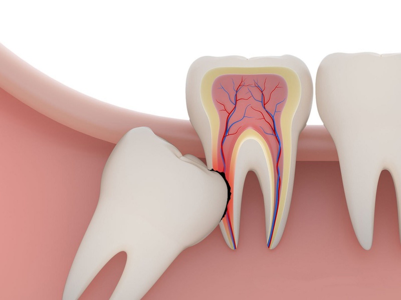 Răng số 8 bị sâu có nên nhổ không? Nhổ răng số 8 có biến chứng nguy hiểm không? 4