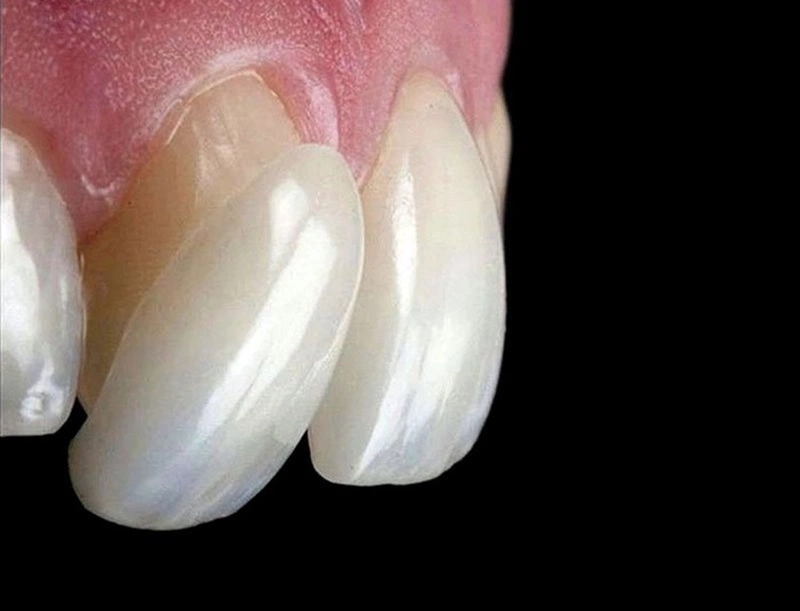 Giải đáp thắc mắc: Dán sứ veneer có ảnh hưởng gì không? 3