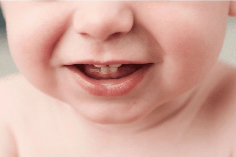 Răng sữa mọc lệch là như thế nào? Nguyên nhân khiến răng sữa mọc lệch 3