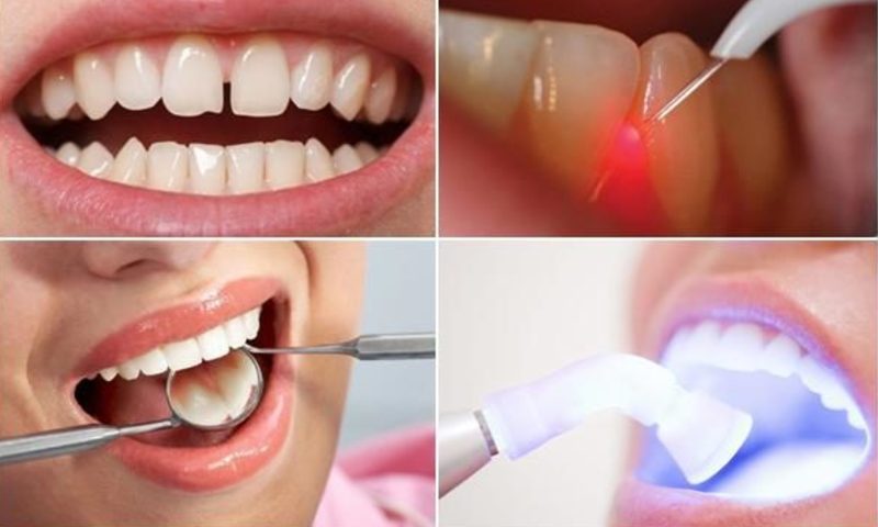 Trám răng thưa sẽ được thực hiện bằng vật liệu trám Composite hay còn được gọi là trám răng thẩm mỹ