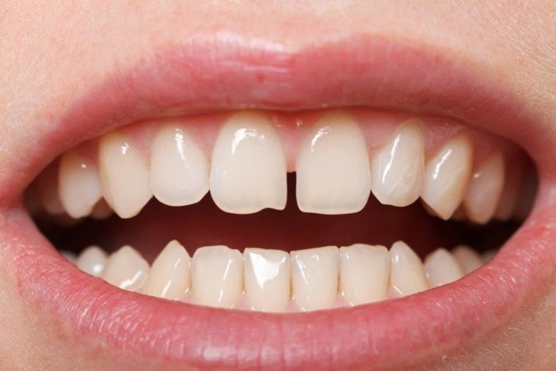 Răng thưa nên làm gì có ảnh hưởng gì không