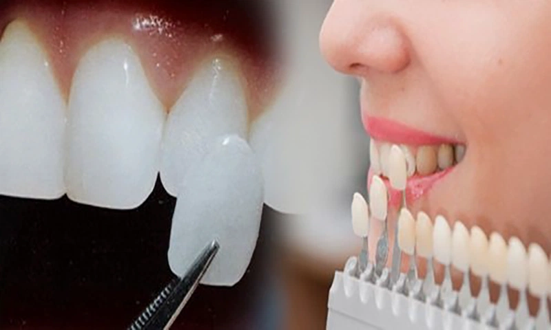 Dán sứ veneer có thể khắc phục tình trạng răng thưa