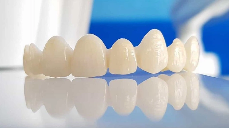 Răng thưa nên niềng hay bọc sứ mới là giải pháp tốt nhất? 3