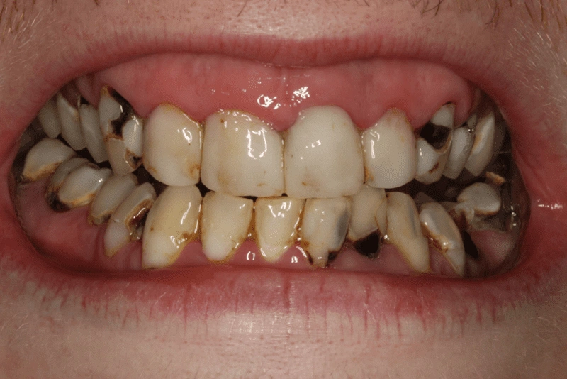 Tình trạng răng bị sâu gây đau nhức và ê buốt thường xuyên