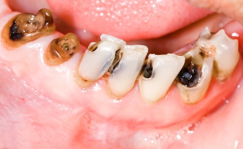 Các nguyên nhân phổ biến khiến răng bị sâu nhiều