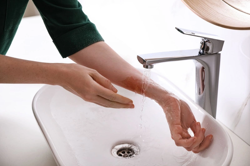 Xử lý vết bỏng như thế nào để không bị sẹo? 1