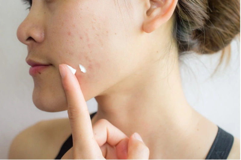 Review gel trị mụn Megaduo có tốt không? Có nên dùng không? 3