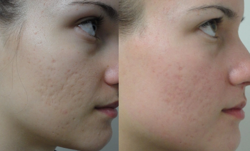 Review kem trị sẹo thủy đậu Scar Esthetique 3