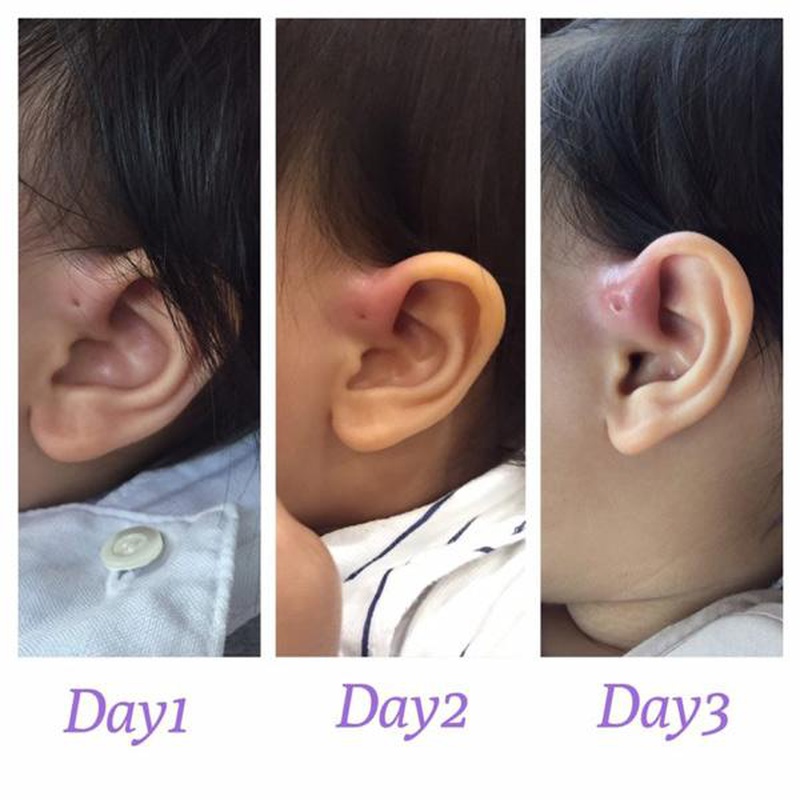 Rò luân nhĩ có nguy hiểm không? Nguyên nhân & dấu hiệu của bệnh là gì? 2