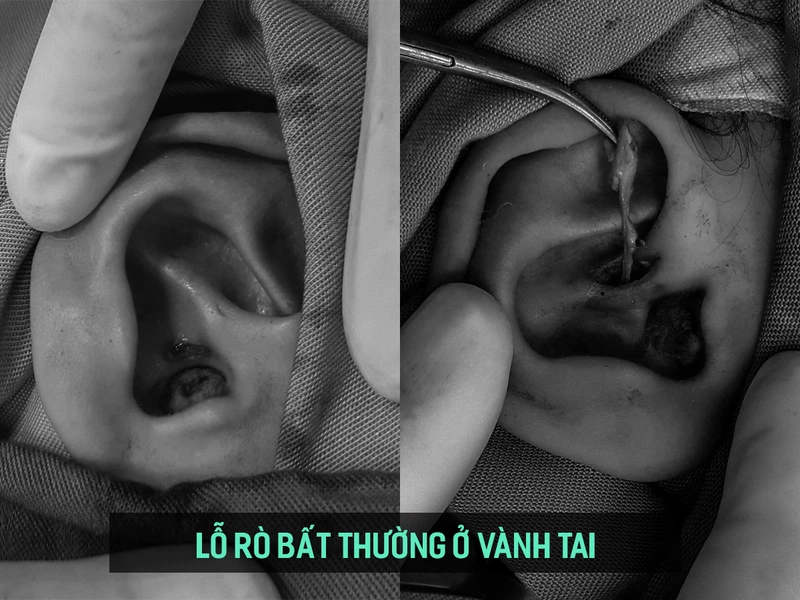 Rò luân nhĩ ở người lớn nguy hiểm không? Cách chữa như thế nào? 2