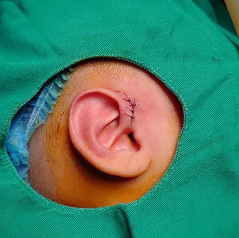 Rò luân nhĩ ở trẻ em có nguy hiểm không? 2