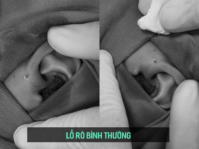 Rò luân nhĩ vệ sinh như thế nào 1