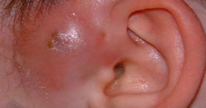 Rò luân nhĩ vệ sinh như thế nào? Các phương pháp điều trị 2