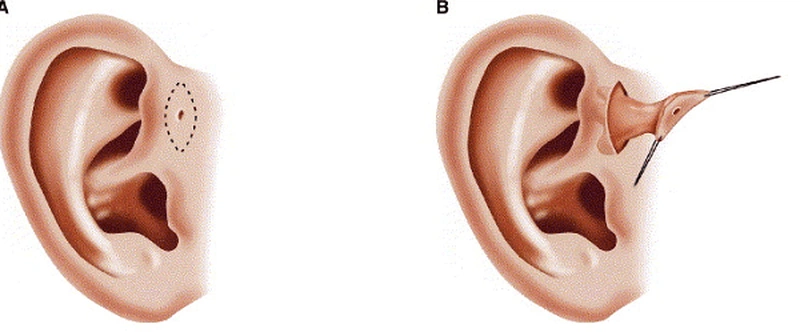 Rò luân nhĩ vệ sinh như thế nào? Các phương pháp điều trị