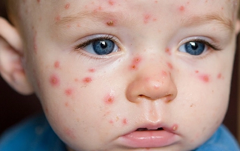 Điều Trị Bệnh Rubella