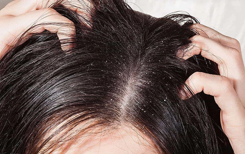Rụng tóc do bệnh da đầu nên làm gì? - Nhà thuốc FPT Long Châu