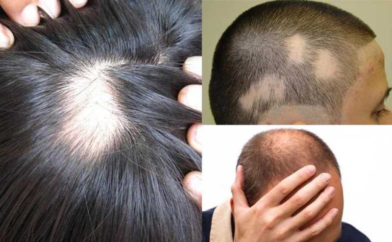 Rụng tóc do bệnh da đầu nên làm gì 2