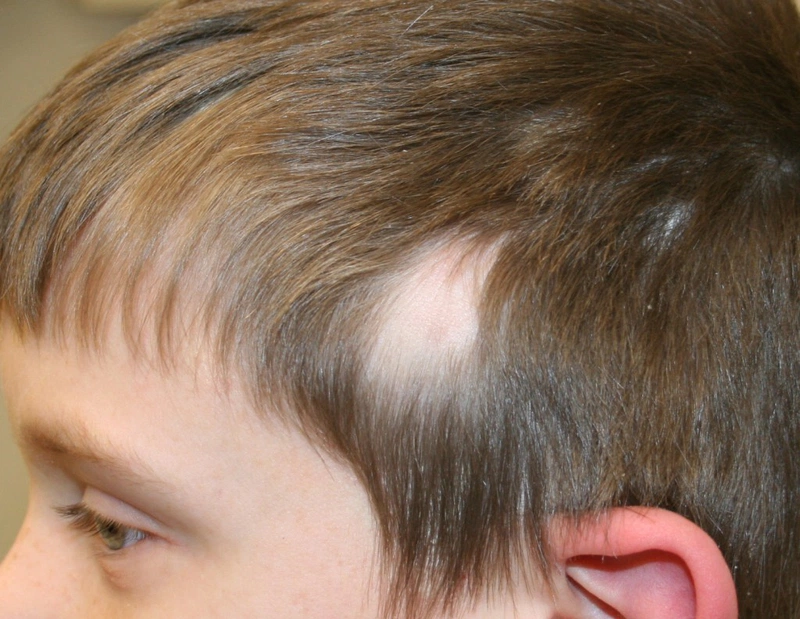 Rụng tóc bệnh lý do các loại nấm da đầu gây nên