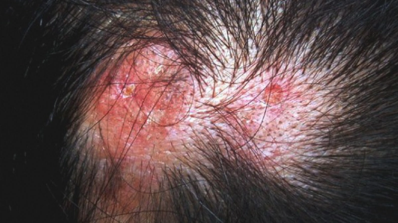 Lupus ban đỏ rụng tóc có nguy hiểm không? Làm thế nào để hạn chế tình trạng này? 1