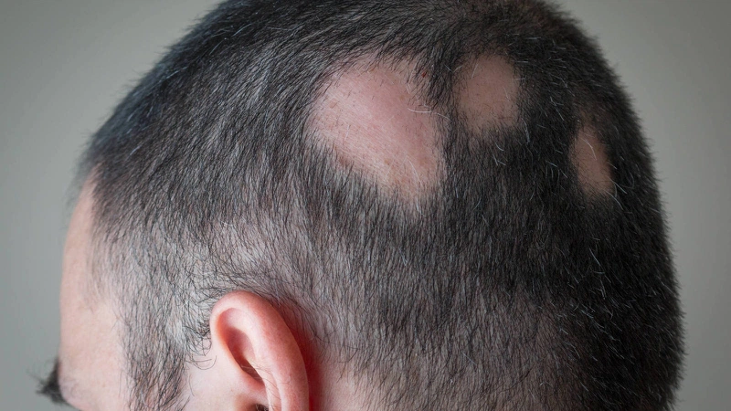 Rụng tóc từng mảng thường gặp ở người bị nấm da đầu