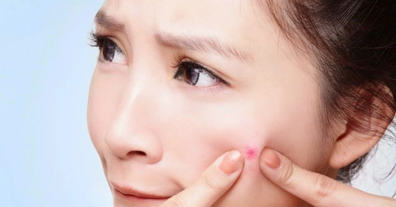 Sản phẩm Decumar có trị thâm không?