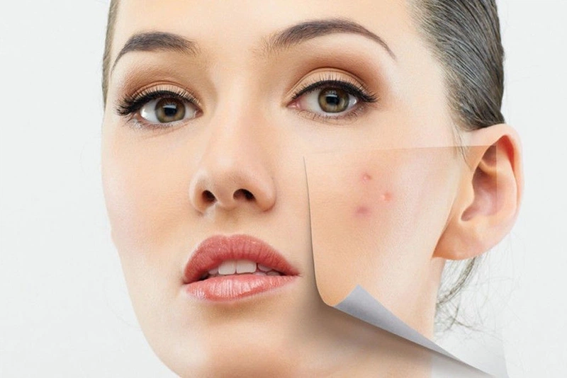 Sản phẩm Decumar có trị thâm không?