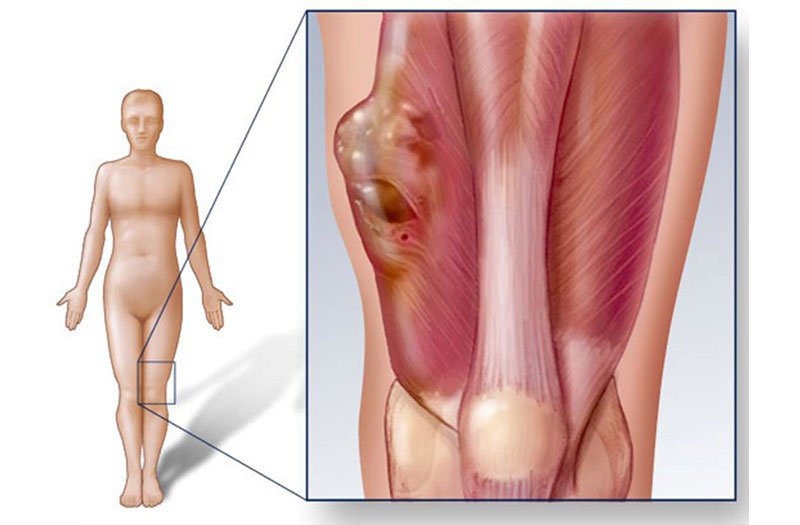 Sarcoma cơ vân ở trẻ em: Khái niệm, phân loại và mô tả 2