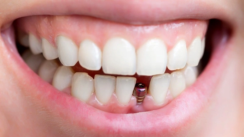 Sau khi nhổ răng bao lâu thì trồng implant là thích hợp? 4